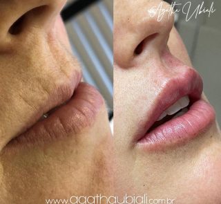 Preenchimento labial com 2,6ml de ácido hialurônico