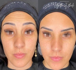 Aplicação de Toxina Botulínica na região da testa