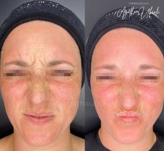 Aplicação de Toxina Botulínica na região do nariz